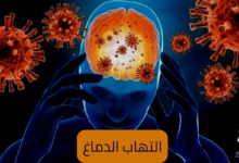 التهاب الدماغ- encephalitis