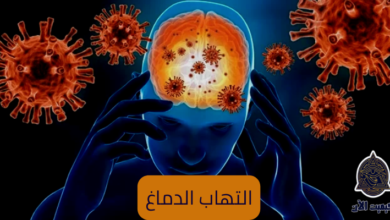 التهاب الدماغ- encephalitis