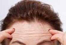 وصفات طبيعية بزيت جوز الهند للقضاء على تجاعيد الجبين 6 وصفات طبيعية بزيت جوز الهند للقضاء على تجاعيد الجبين